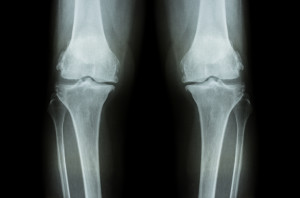 Osteoarthritis Knee ( OA Knee ). Film x-ray both knee ( front view ) show narrow joint space ( joint cartilage loss ) , osteophyte , subchondral sclerosis